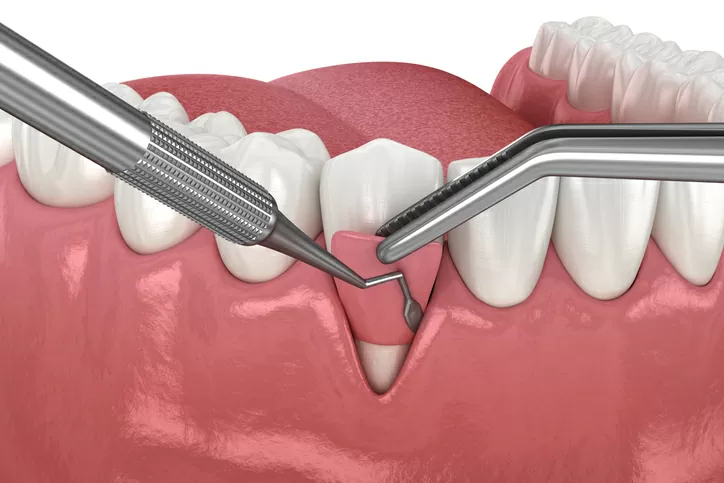 Oral and Gum Surgeries